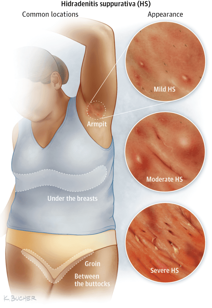 Hidradenitis Suppurativa - Pennsylvania Dermatology Specialists